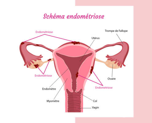 Endometriose-physiotherapie-geneve-rive-actv-sante-2