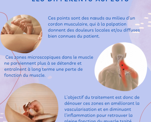 dry-needling-douloureux-muscle-tension