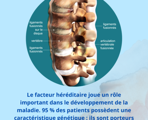 Spondylarthrite-ankylosante-polyarthrite-rhumatoide-