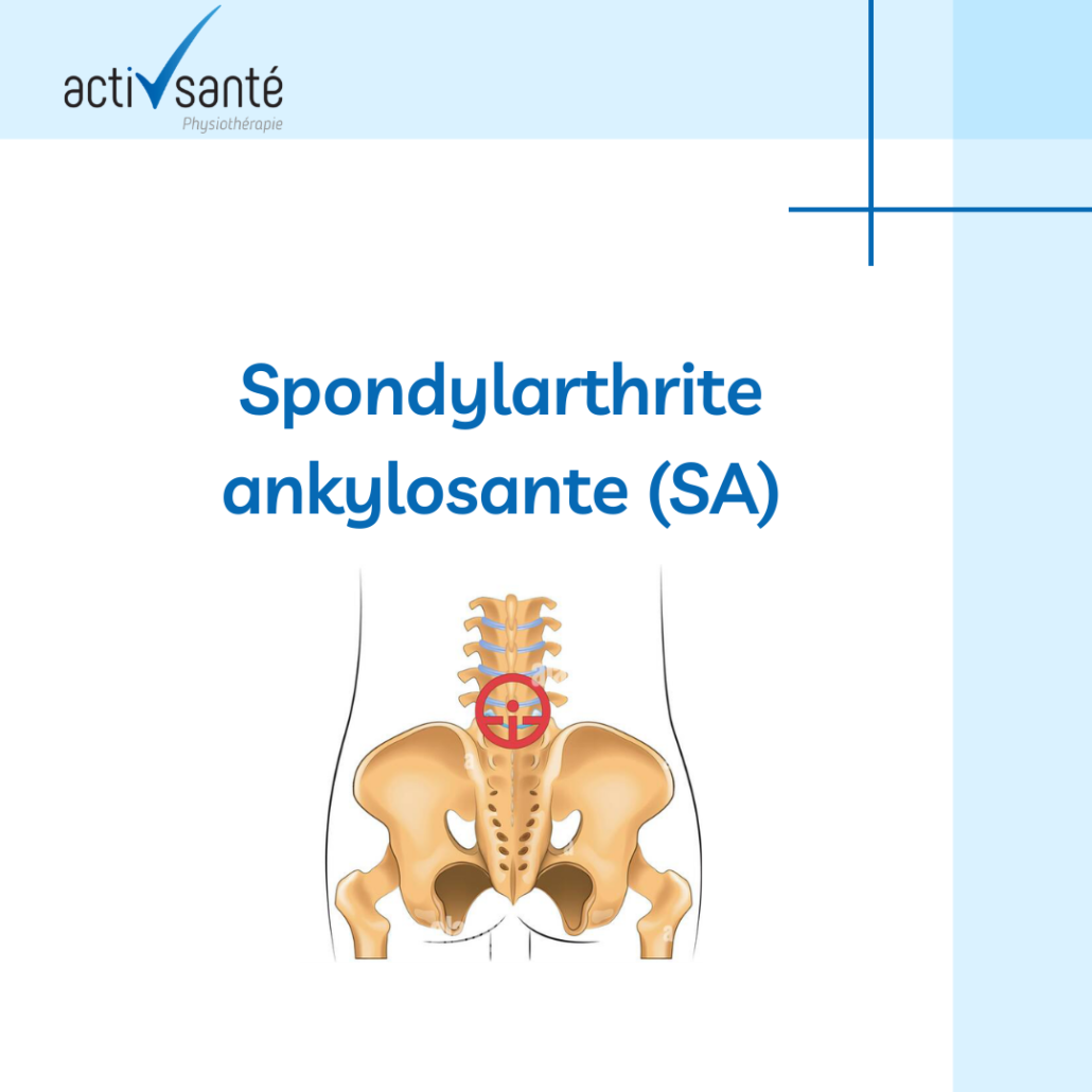 Spondylarthrite-ankylosante-soulager-naturellement-soigner
