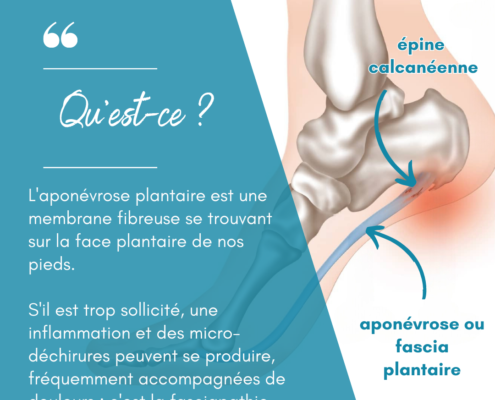 fasciapathie-plantaire-activ-sante-voute-pied-geneve-2-qu-est-ce